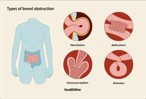 gastric sleeve leak symptoms|Bowel Obstruction after WLS: Causes, Symptoms and Treatments